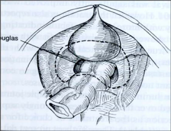 cytoreductive surgery - pelvic peritonectomy