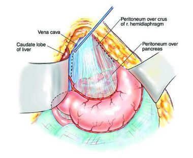 peritoneal malignancy